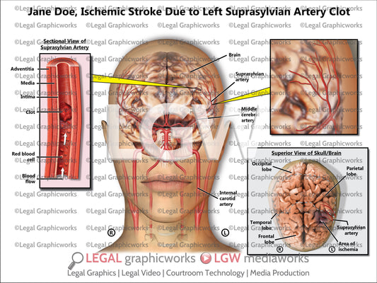 Ischemic Stroke Due to Left Suprasylvian Artery Clot