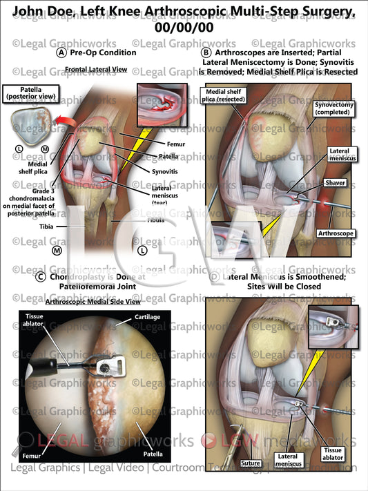 Left Knee Arthroscopic Multi-Step Surgery