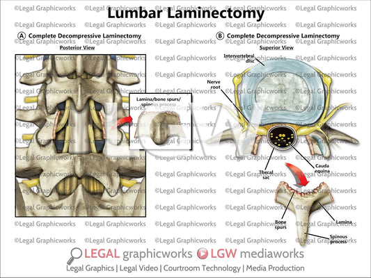 Lumbar Laminectomy