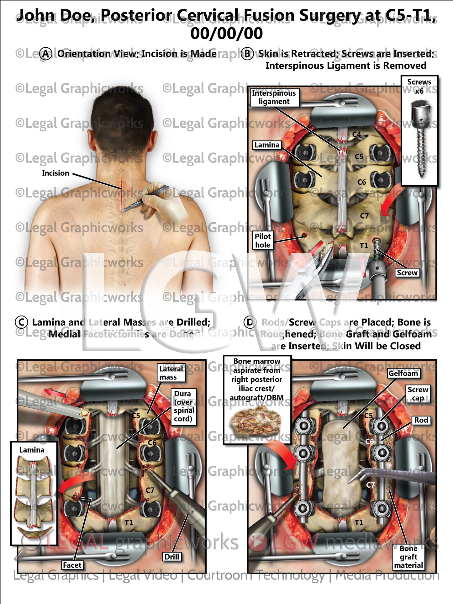 Posterior Cervical Fusion Surgery at C5-T1