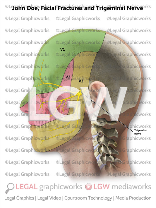 Facial Fractures and Trigeminal Nerve