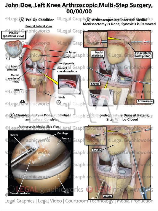 Left Knee Arthroscopic Multi-Step Surgery