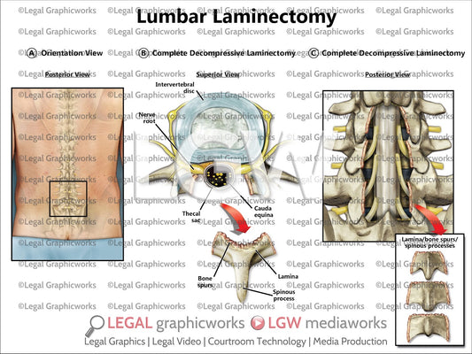 Lumbar Laminectomy