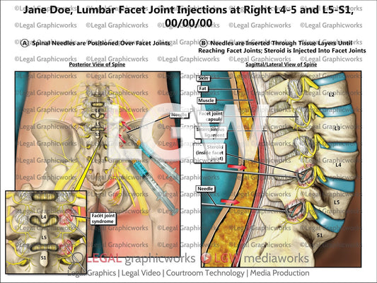 Lumbar Facet Joint Injections at Right L4-5 and L5-S1