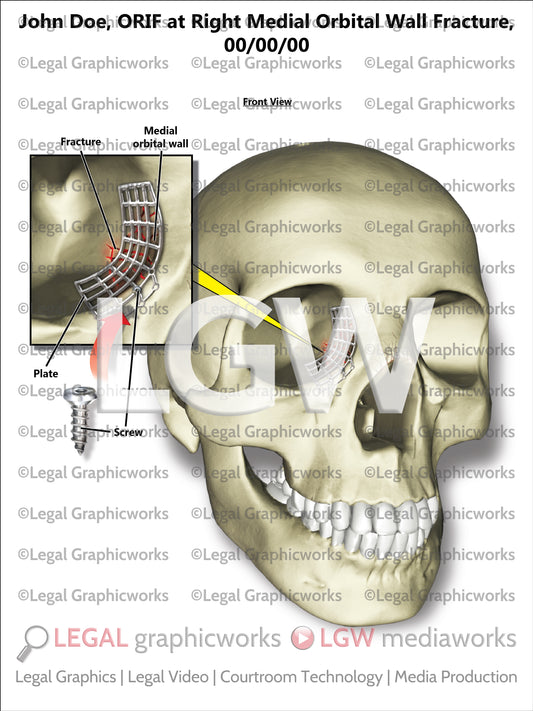 ORIF at Right Medial Orbital Wall Fracture