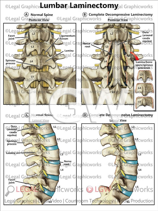 Lumbar Laminectomy