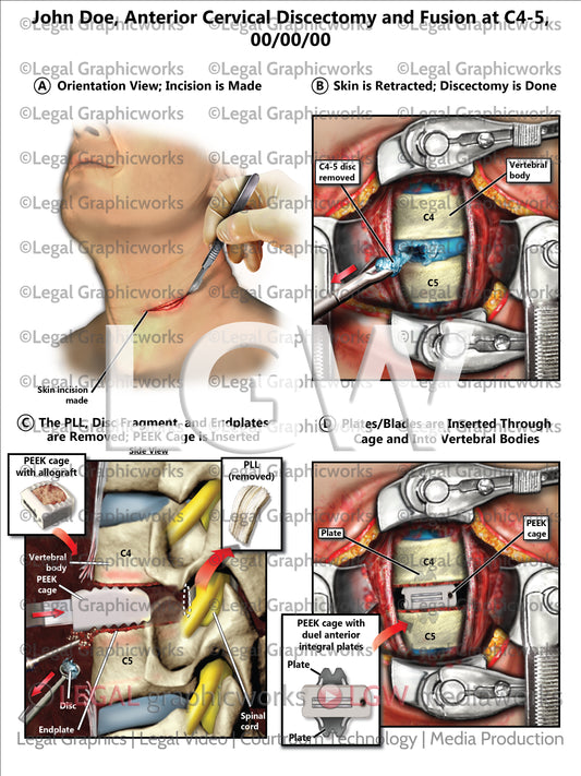 Anterior Cervical Discectomy and Fusion at C4-5