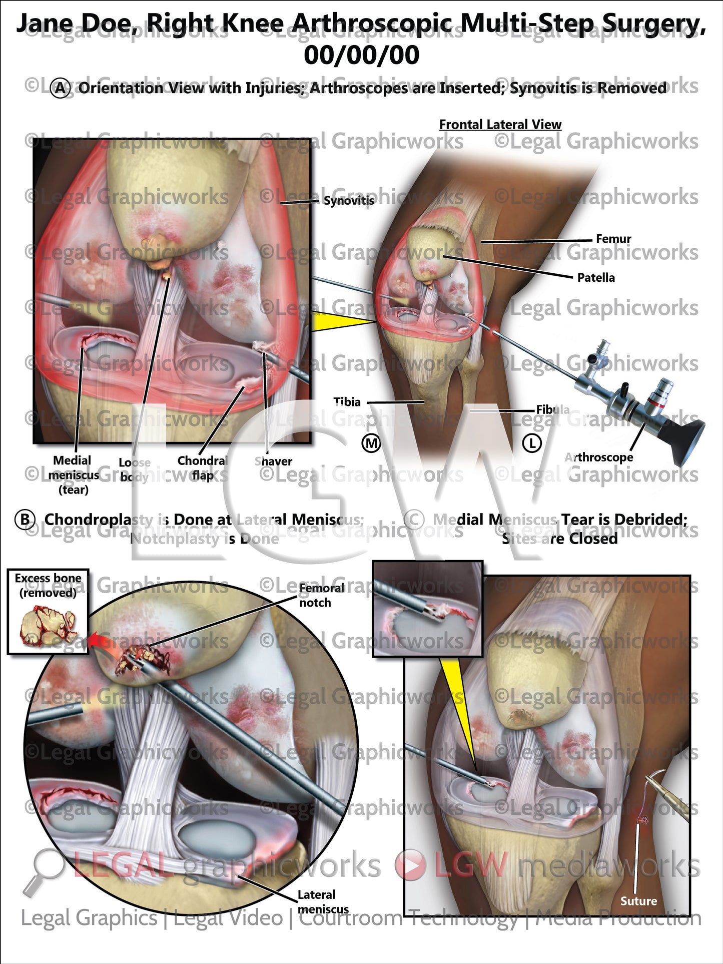 Right Knee Arthroscopic Multi-Step Surgery