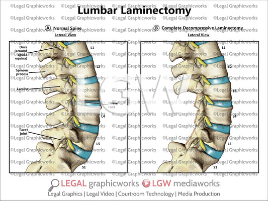 Lumbar Laminectomy