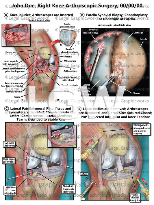 Right Knee Arthroscopic Surgery