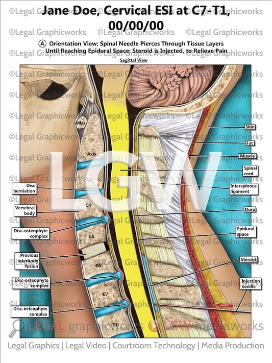 Cervical ESI at C7-T1