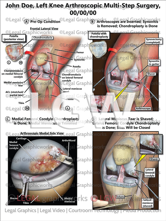 Left Knee Arthroscopic Multi-Step Surgery