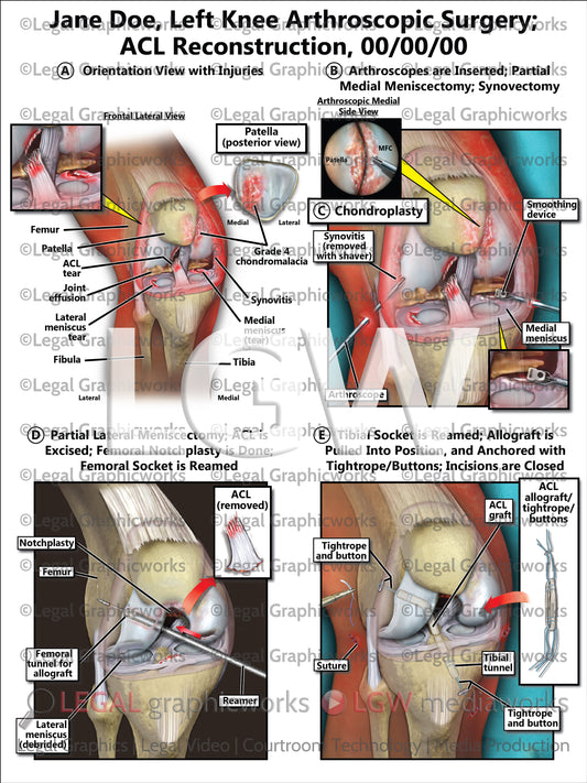 Left Knee Arthroscopic Surgery; ACL Reconstruction
